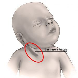 Torcicollo miogeno