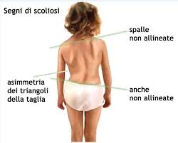 scoliosi idiopatica - Areafisio Riabilitazione Pediatrica