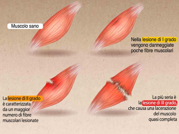 lesione muscolare - Areafisio Manerba
